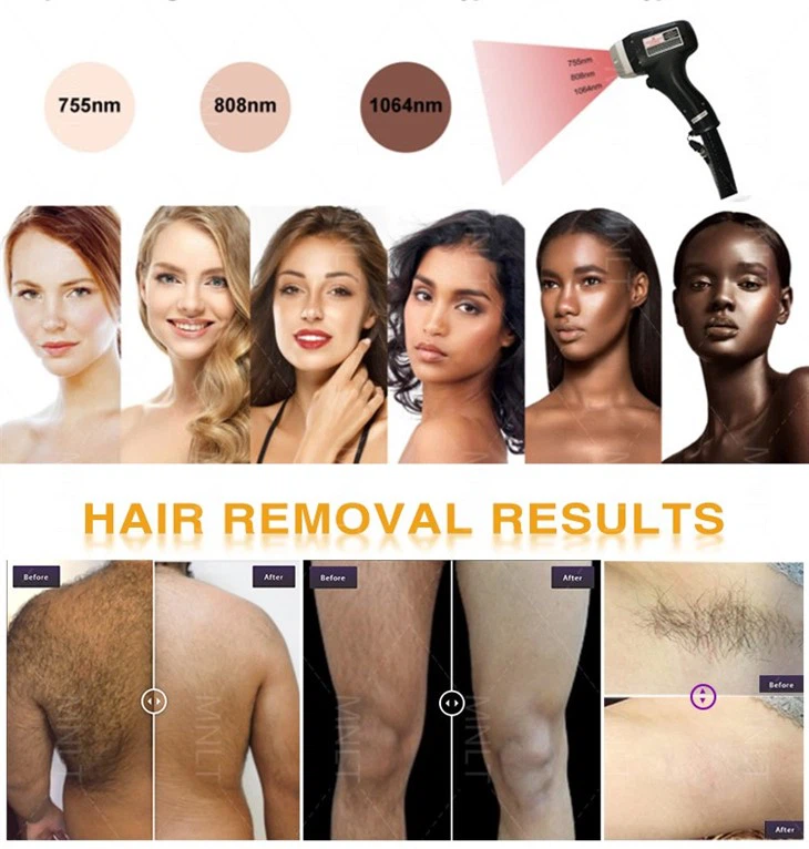 Painless Diode Laser Hair Removal Machine